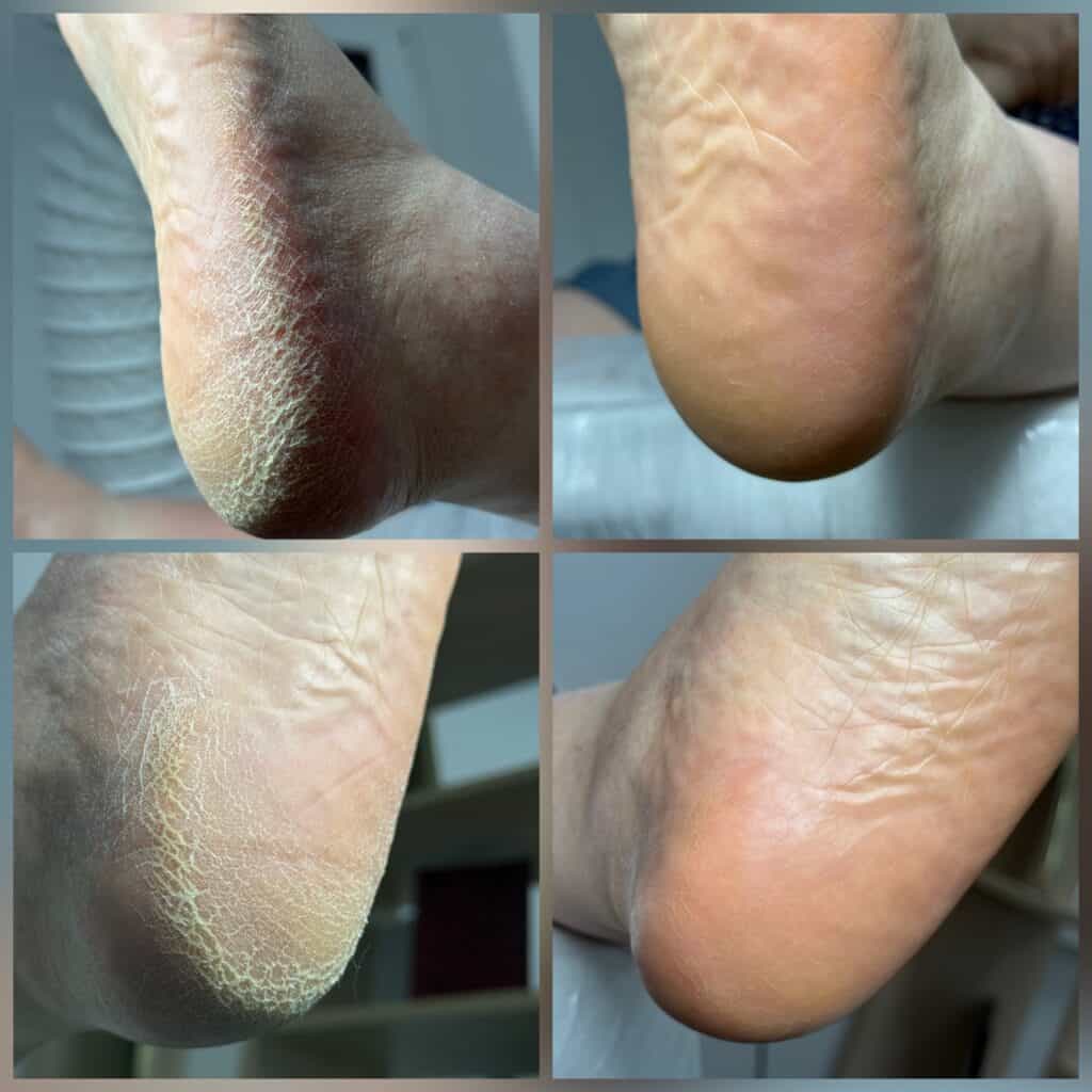 Уход за пятачками, восстановление кожи ног, пилинг и гидратация.