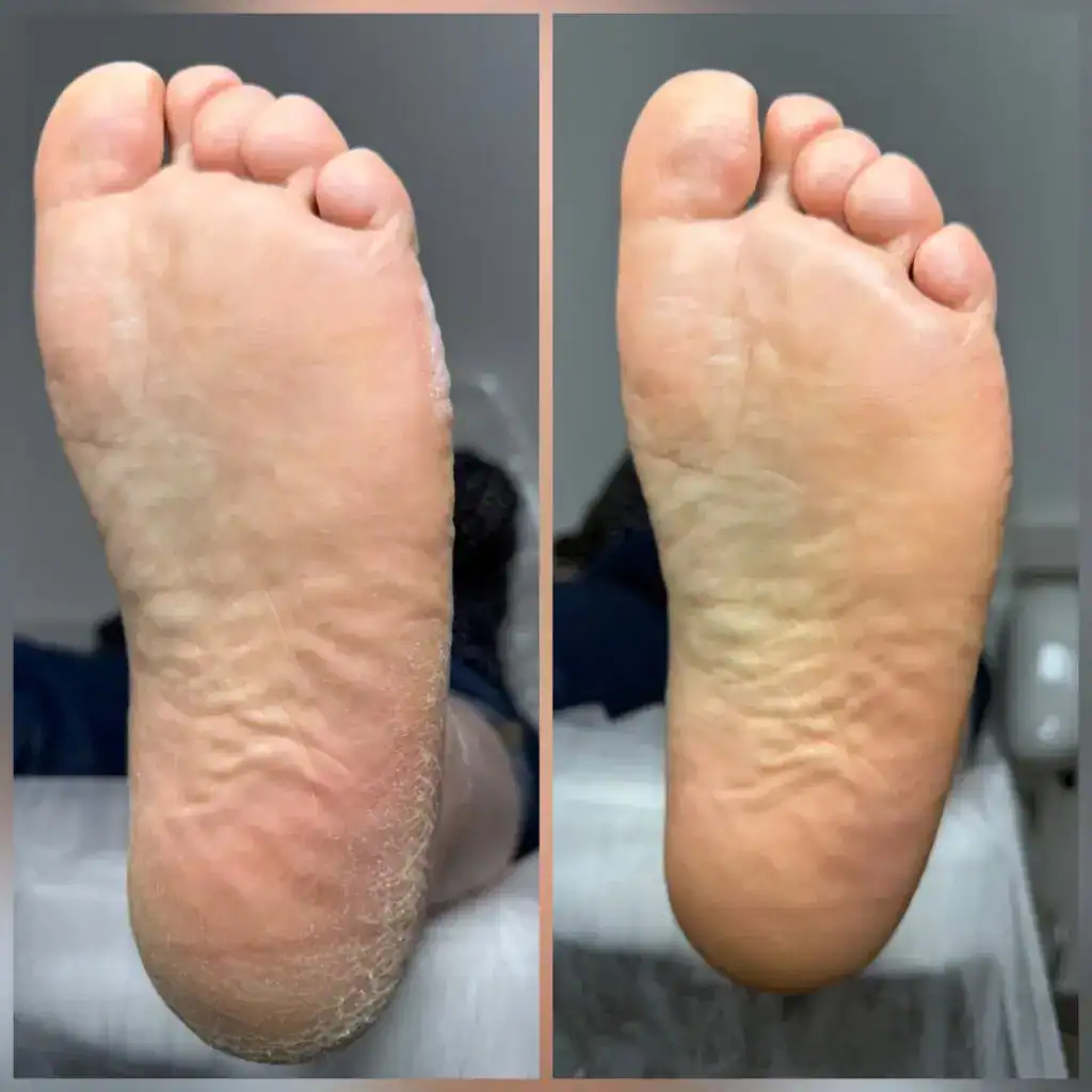 Уход за стопами: лечение сухой и потрескавшейся кожи, педикюр в Санкт-Петербурге.