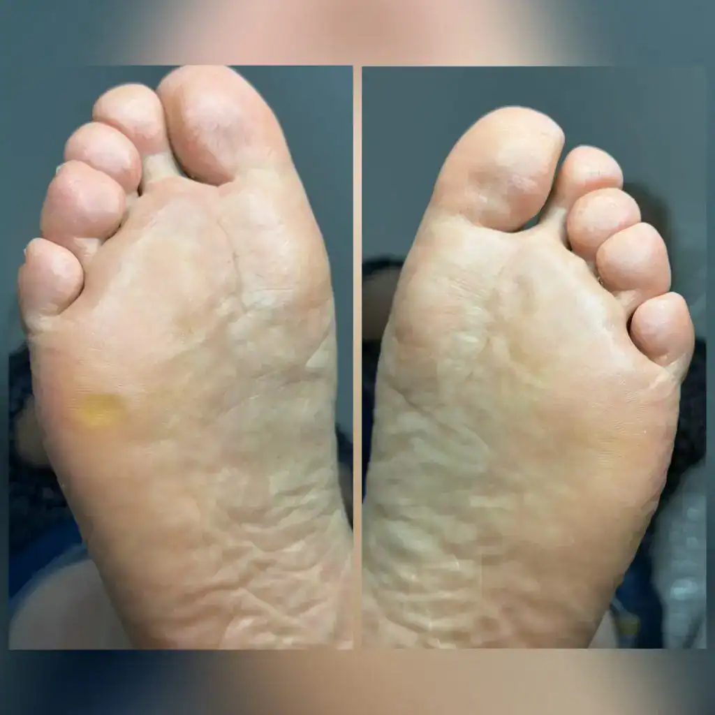 Избавление от натоптышей и ухоженная кожа на стопах.