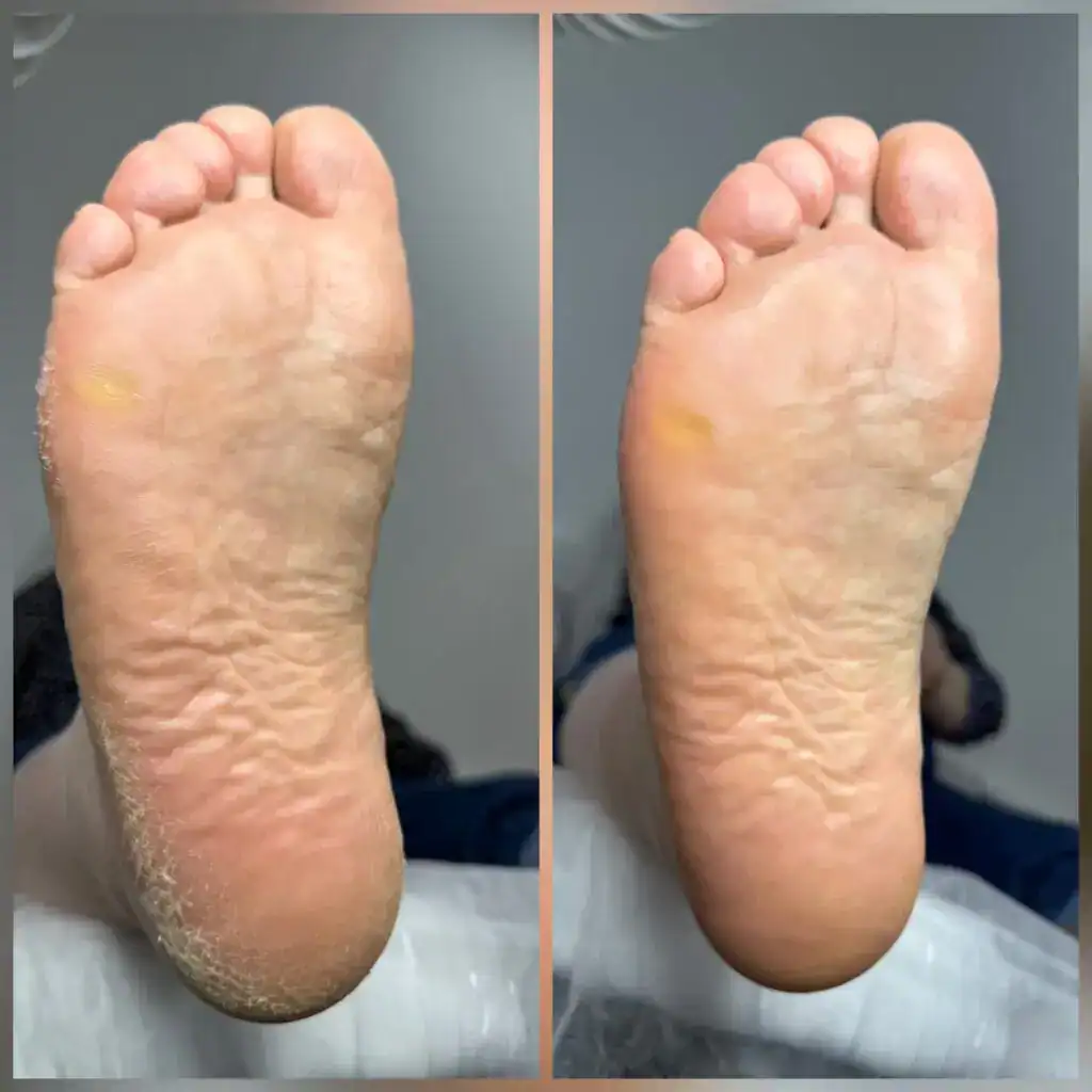 ALT: Стопы до и после ухода в студии Екатерины Силиной, пилинг, увлажнение.