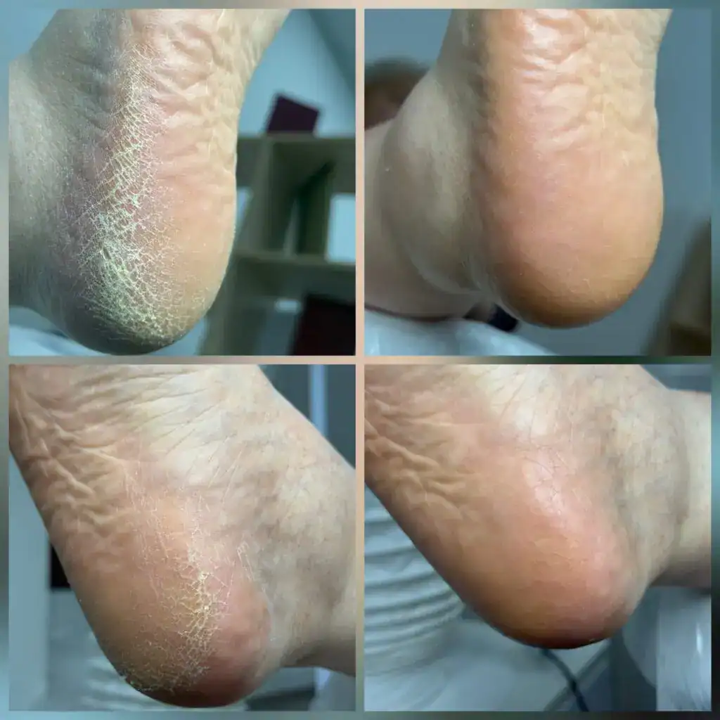 ALT: Ухоженные пятки, мягкая кожа ног после процедуры в студии Екатерины Силиной.