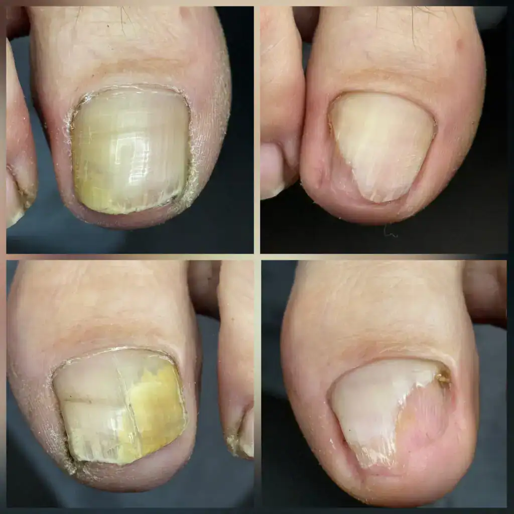 Обработка ногтей, удаление грибка, уход за ногтями и кутикулой, профессиональная помощь.